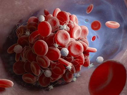 close up of red blood clots in ball shape with a few floating away to the right. photo credit: https://www.centerforvein.com/blog/how-to-check-for-blood-clots-at-home
